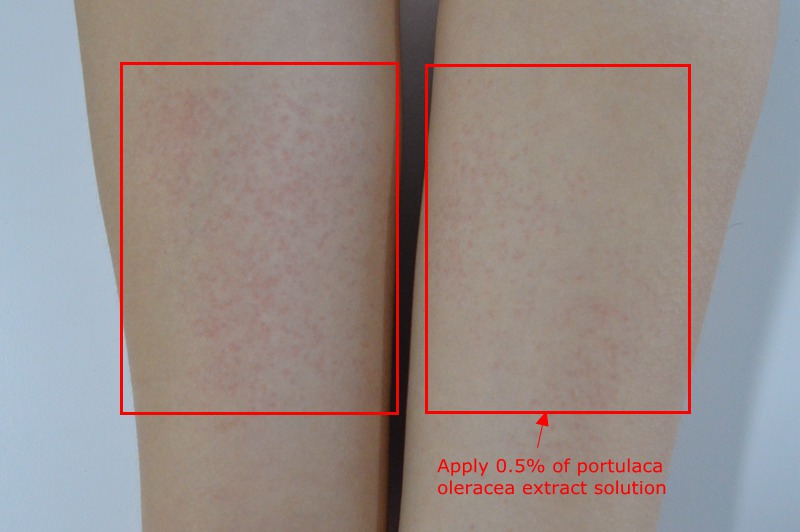 portulaca oleracea extract for anti allergy