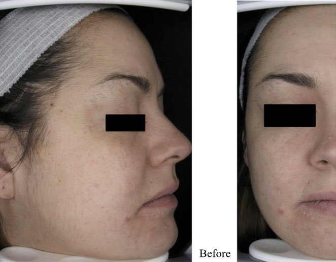portulaca oleracea extract for facial skin