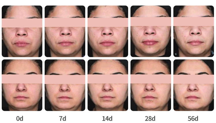 clinical trial of glabridin skin whitening